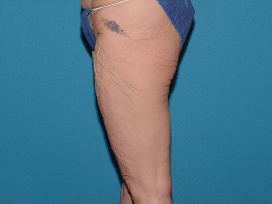 Thigh Lift: Case 1- Carmel - Before