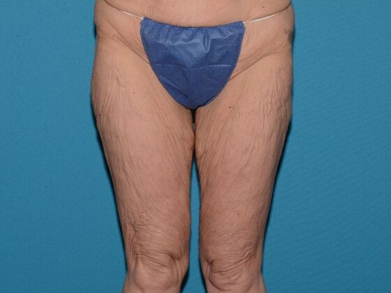 Thigh Lift Case 1- Carmel - Before