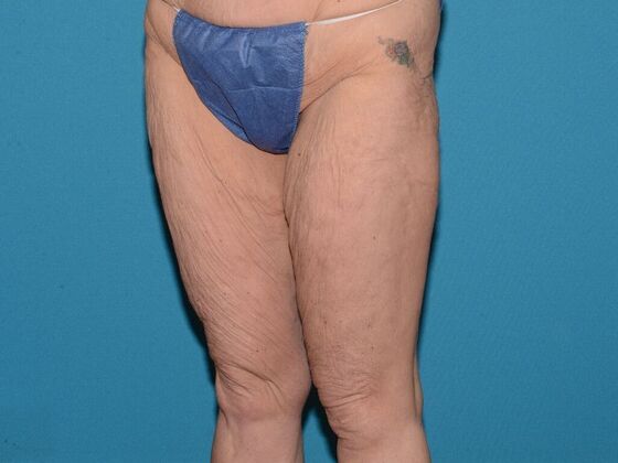 Thigh Lift: Case 1- Carmel - Before