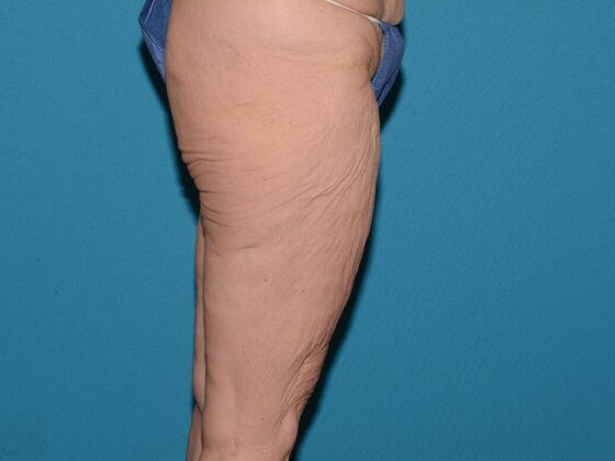 Thigh Lift: Case 1- Carmel - Before