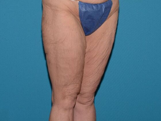 Thigh Lift: Case 1- Carmel - Before