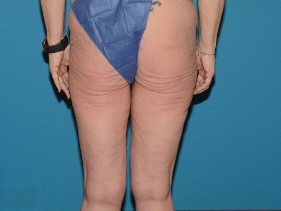 Thigh Lift: Case 1- Carmel - Before