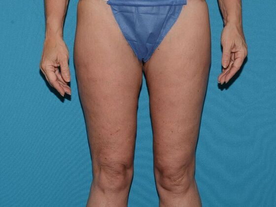 Thigh Lift Case 1- Carmel - After