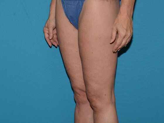 Thigh Lift: Case 1- Carmel - After