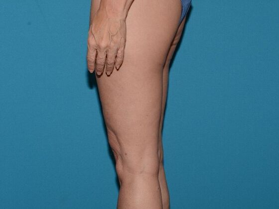 Thigh Lift: Case 1- Carmel - After