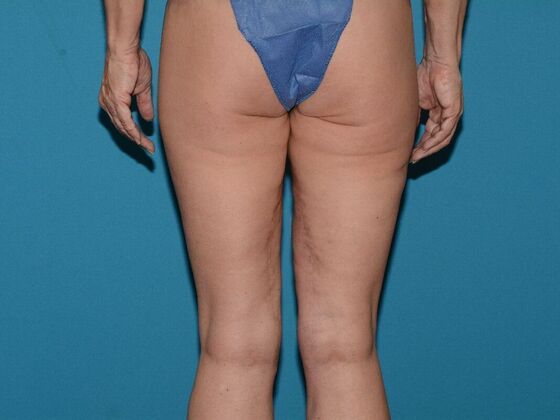 Thigh Lift: Case 1- Carmel - After