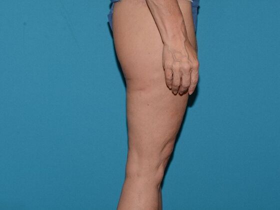 Thigh Lift: Case 1- Carmel - After