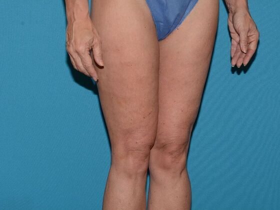 Thigh Lift: Case 1- Carmel - After