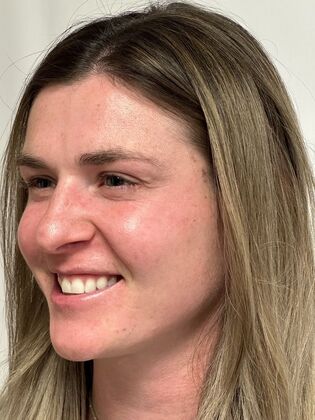 Injectables Botox, Dysport Neuromodulators Case 10 (34924) - After