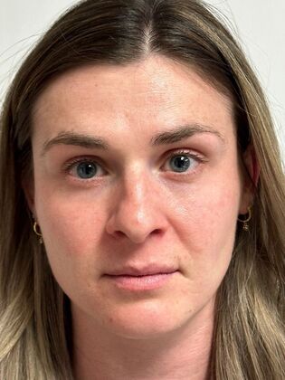 Injectables Botox, Dysport Neuromodulators: Case 10 (34924) - After