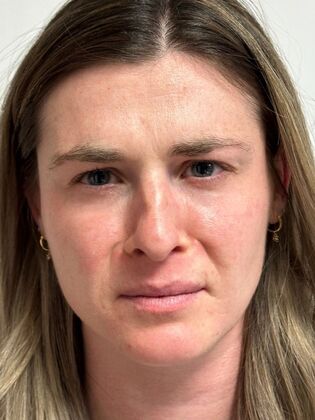 Injectables Botox, Dysport Neuromodulators: Case 10 (34924) - After