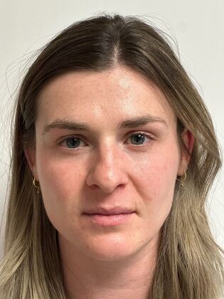 Injectables Botox, Dysport Neuromodulators: Case 10 (34924) - After