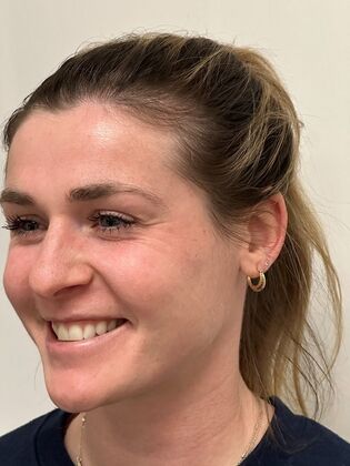 Injectables Botox, Dysport Neuromodulators Case 10 (34924) - Before