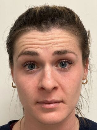 Injectables Botox, Dysport Neuromodulators: Case 10 (34924) - Before