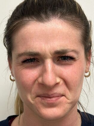 Injectables Botox, Dysport Neuromodulators: Case 10 (34924) - Before