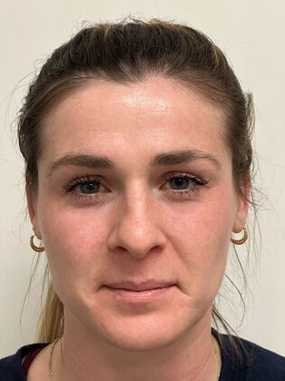 Injectables Botox, Dysport Neuromodulators: Case 10 (34924) - Before