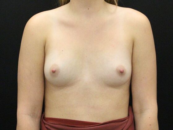 Breast Augmentation: Case 94 - Before