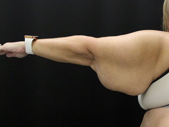 Arm Lift Case 21 - Before