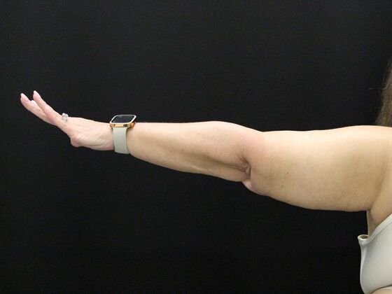 Arm Lift Case 21 - After