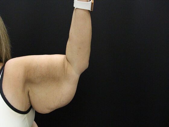 Arm Lift: Case 21 - Before