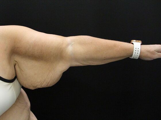 Arm Lift: Case 21 - Before