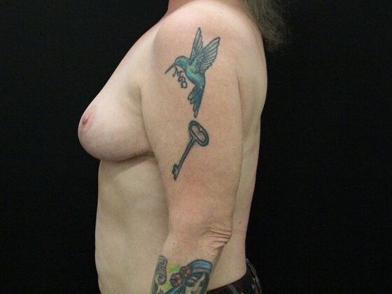 Breast Reduction: Case 27 - After