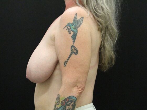 Breast Reduction: Case 27 - Before
