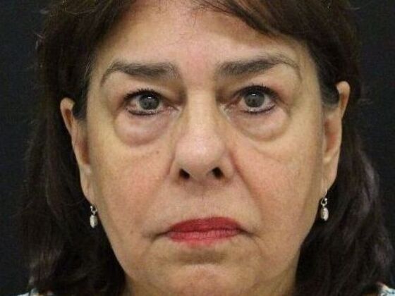 Eyelid Surgery: Case 11 - Before