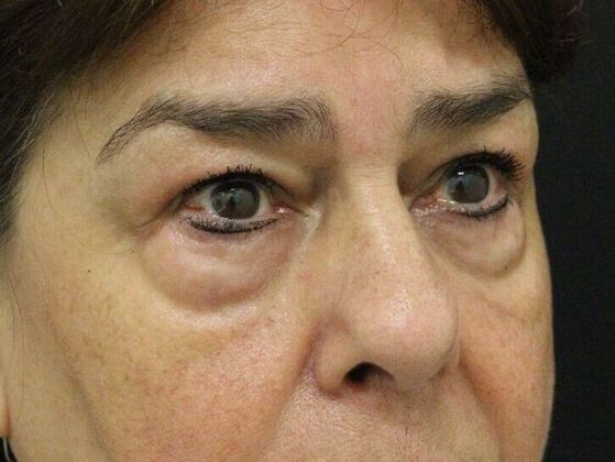 Eyelid Surgery: Case 11 - Before