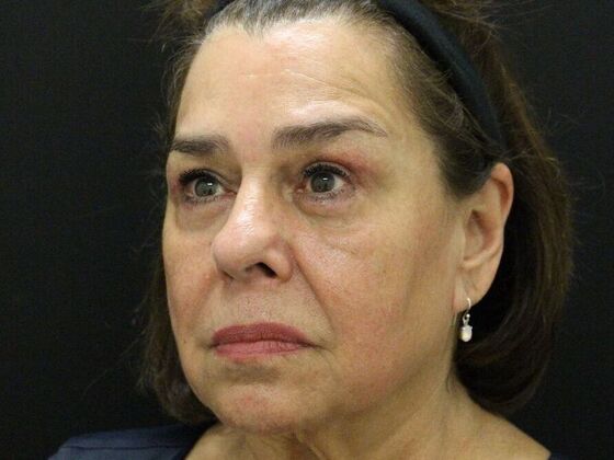 Eyelid Surgery: Case 11 - After