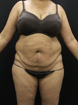 Tummy Tuck Case 59 - Before