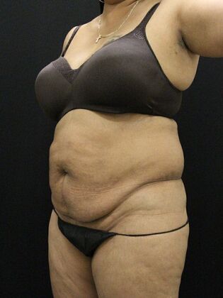 Tummy Tuck: Case 59 - Before