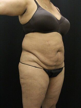 Tummy Tuck: Case 59 - Before