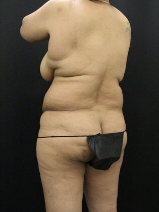 Tummy Tuck: Case 59 - Before