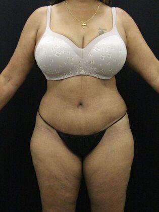 Tummy Tuck Case 59 - After