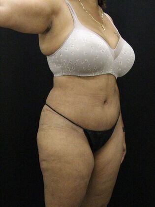 Tummy Tuck: Case 59 - After