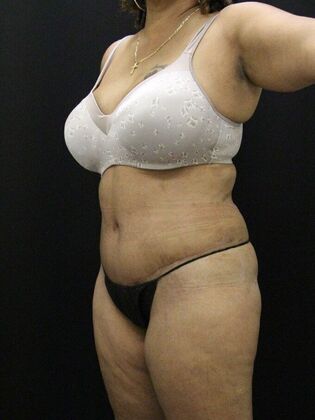 Tummy Tuck: Case 59 - After