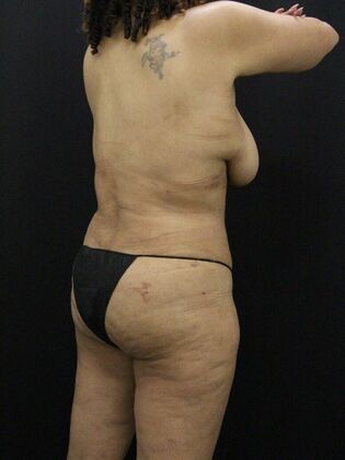 Tummy Tuck: Case 59 - After