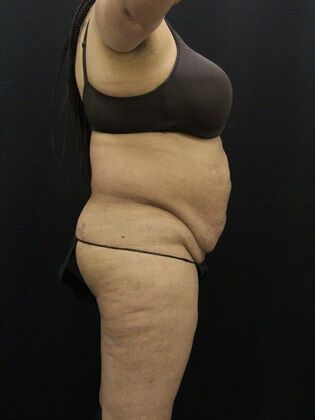 Tummy Tuck: Case 59 - Before