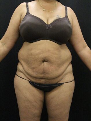 Liposuction Case 28 - Before
