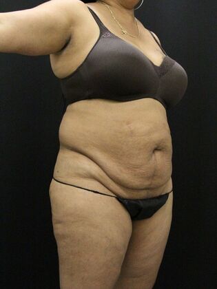 Liposuction: Case 28 - Before