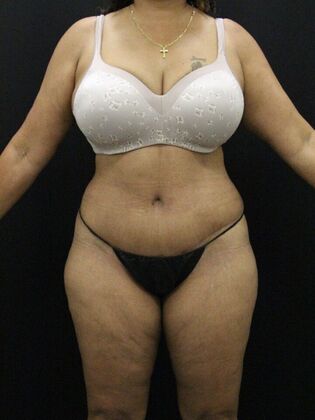 Liposuction Case 28 - After