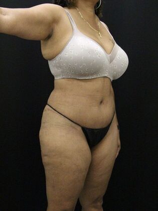 Liposuction: Case 28 - After