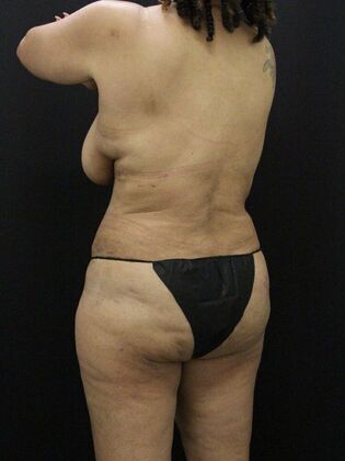 Liposuction: Case 28 - After