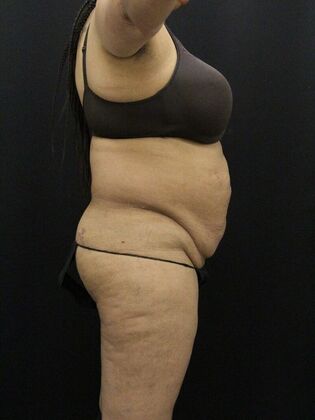 Liposuction: Case 28 - Before