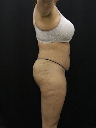 Liposuction: Case 28 - After