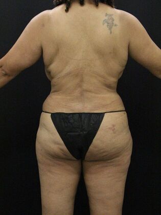 Liposuction: Case 28 - After