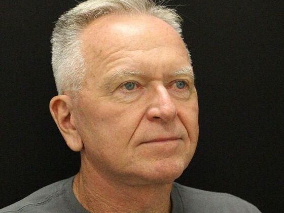 Face & Neck Lifts: Case 32 - After