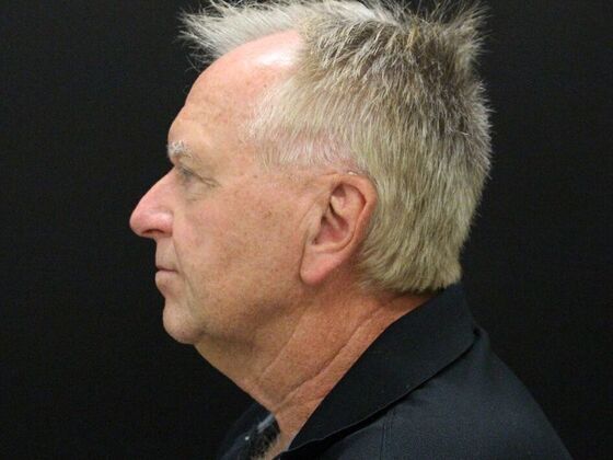 Face & Neck Lifts: Case 32 - Before