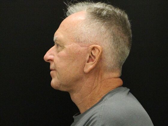 Face & Neck Lifts: Case 32 - After